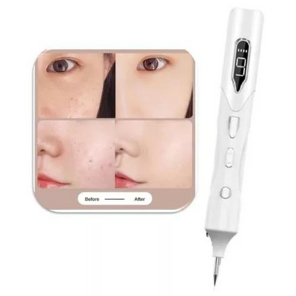 PLASMAPEN® | Tu piel libre de verrugas, lunares y manchas